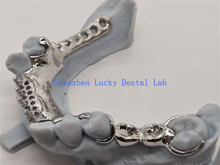 3D Print Metal Framework med legeringsstøttet tanndesign