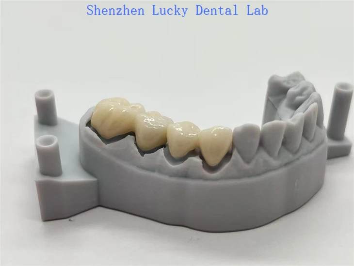 Full Contour Zirconia Bridge